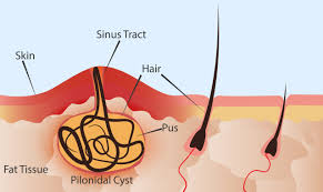 Fast healing through pilonidal cyst treatment with laser in Tehran